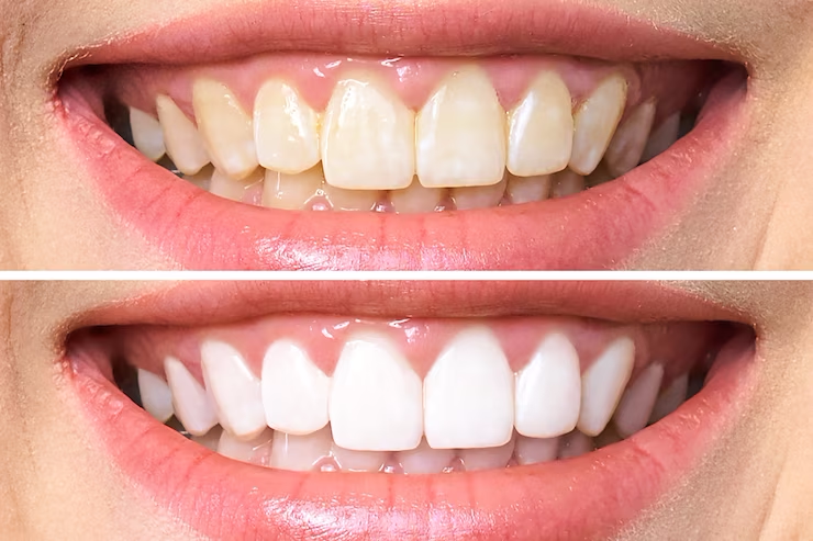 dentes-antes-e-depois-do-clareamento_168410-587-1.png
