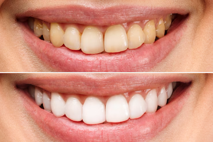 dentes-da-mulher-antes-e-depois-do-clareamento-sobre-fundo-branco_168410-1693-1.png